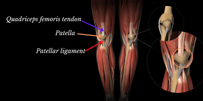 runner's knee